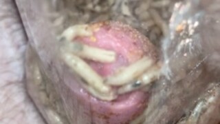 Maggots stuffing foreskin