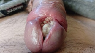 Maggots in slit urethra playing